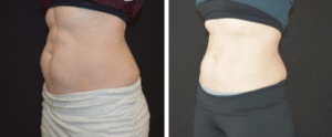 emsculpt neo before and after; coolsculpting alternatives